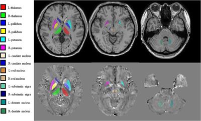 Iron Deposition Characteristics of Deep Gray Matter in Elderly Individuals in the Community Revealed by Quantitative Susceptibility Mapping and Multiple Factor Analysis